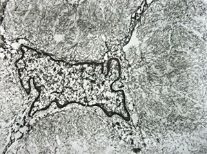 M,56y. | amyloidosis - tendon